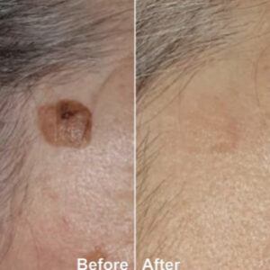 Age Spots before & After