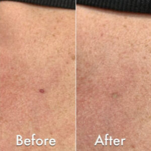 Campbell De Morgan Spots Before & After