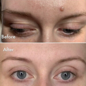 Moles before & after
