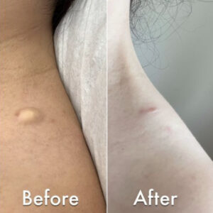 Sebaceous Cysts before & after