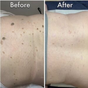 Seborrheic Keratosis before & after