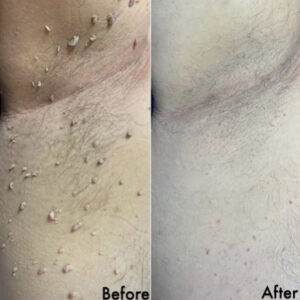 Skin Tags before & after