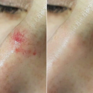 Spider Naevus before & after