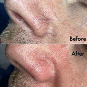 Telangiectasis before & after