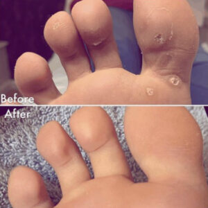 Verruuca before & after