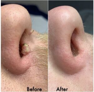 Warts before & after
